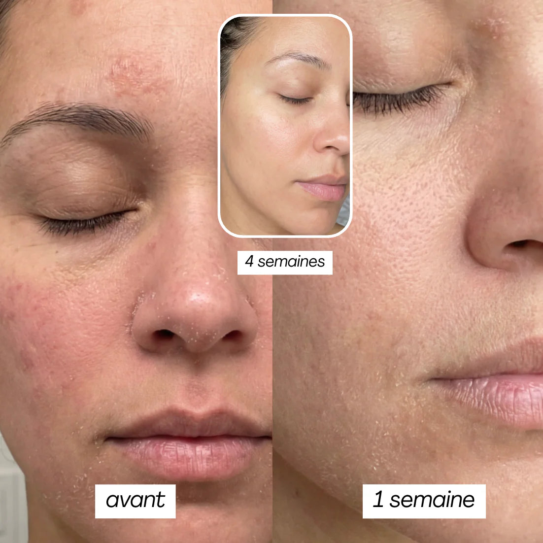 PEAU SÈCHE - MASQUE JELLY